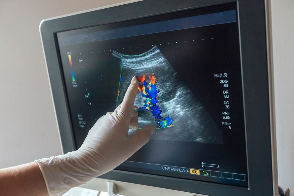 Monitor de ultrassom com Doppler colorido exibindo fluxo sanguíneo renal para avaliação de risco cardiovascular na Lagos Scan em Araruama.