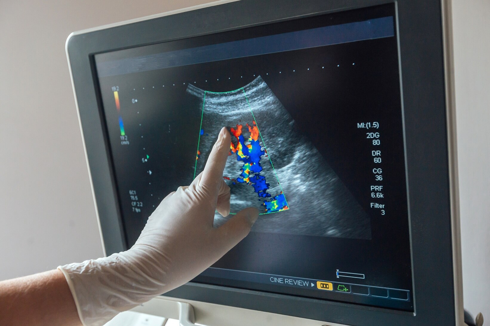 Monitor de ultrassom com Doppler colorido exibindo fluxo sanguíneo renal para avaliação de risco cardiovascular na Lagos Scan em Araruama.